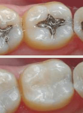 White-Fillings-Before-After