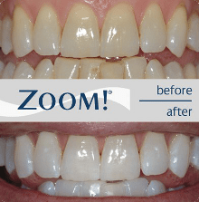zoom-before-after
